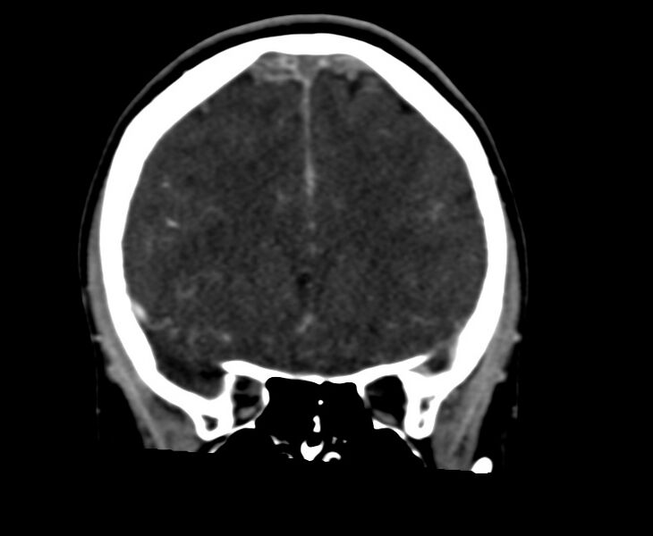 File:Cerebral venous sinus thrombosis (Radiopaedia 59224-66646 Coronal C+ delayed 23).jpg
