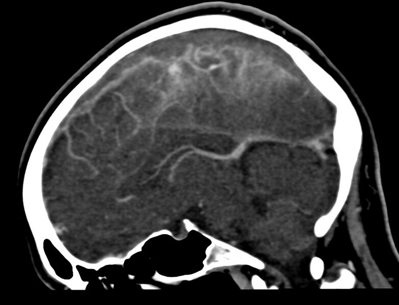 File:Cerebral venous sinus thrombosis (Radiopaedia 59224-66646 Sagittal C+ delayed 23).jpg