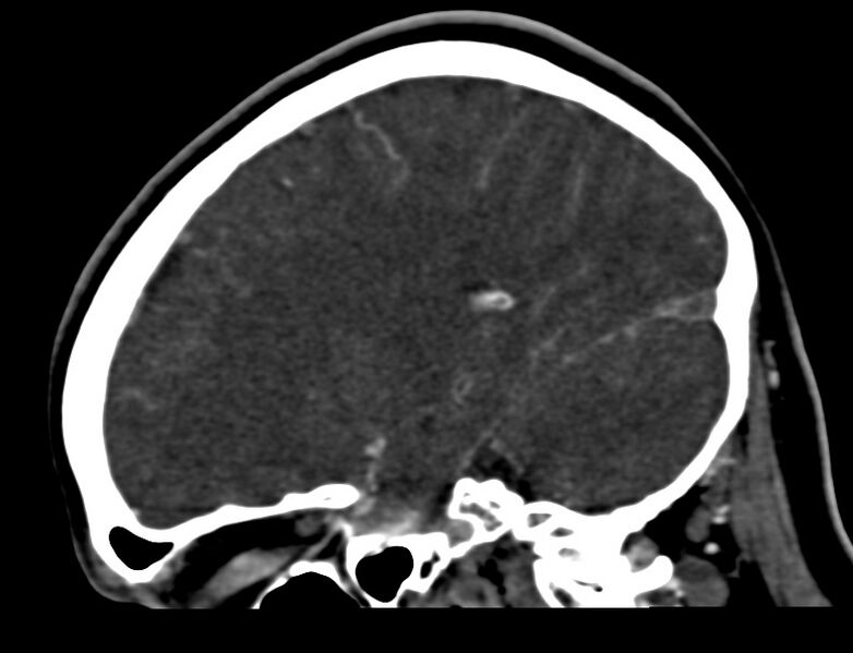 File:Cerebral venous sinus thrombosis (Radiopaedia 59224-66646 Sagittal C+ delayed 39).jpg