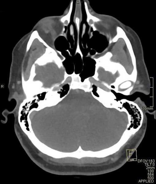 File:Cerebral venous sinus thrombosis (Radiopaedia 91329-108965 Axial venogram 21).jpg