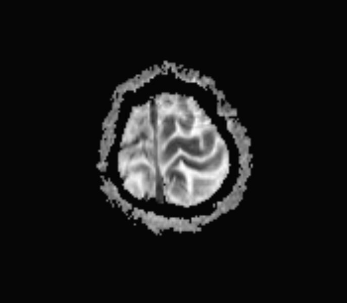 File:Cerebral venous thrombosis (Radiopaedia 71207-81504 Axial ADC 18).jpg