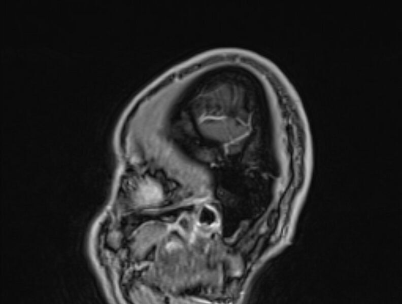 File:Cerebral venous thrombosis (Radiopaedia 71207-81504 Sagittal T1 C+ 1).jpg