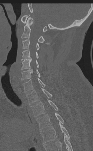 File:Cervical canal stenosis due to ossification of the posterior longitudinal ligament (Radiopaedia 47260-51823 Sagittal bone window 33).png