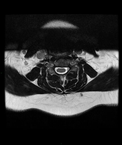 File:Cervical disc prolapse (Radiopaedia 80258-93598 Axial T2 30).jpg