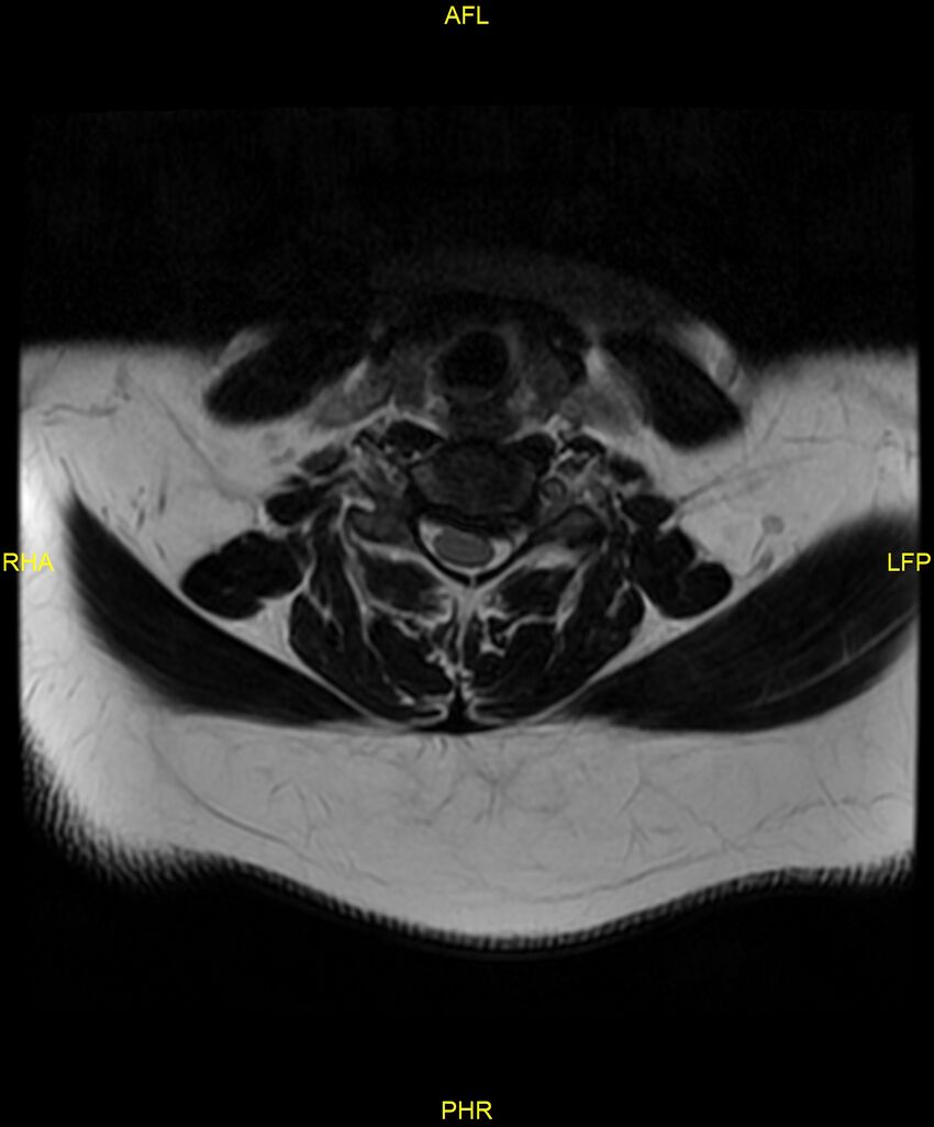 Cervical disc protrusion (Radiopaedia 87147-103415 Axial T2 39).jpg