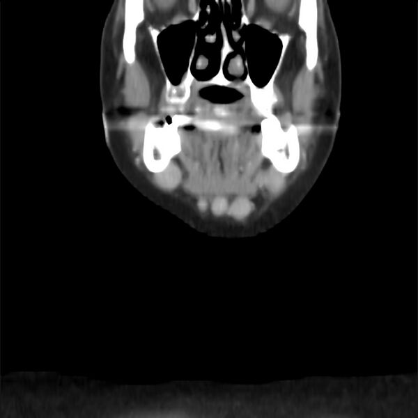 File:Cervical lymphadenopathy. cause unknown (Radiopaedia 22420-22457 None 147).jpg