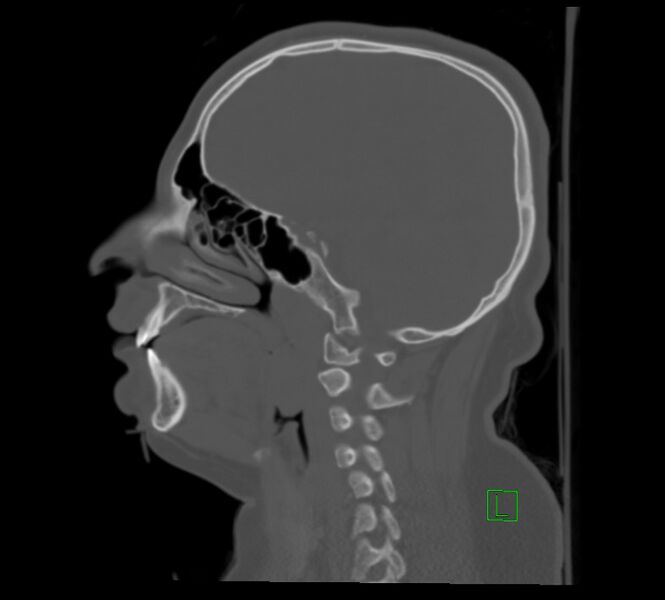 File:Cervical spine fracture - hyperflexion injury (Radiopaedia 66184-75364 A 10).jpg