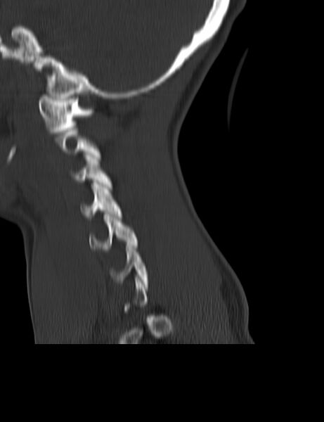 File:Cervical spine posterior ligamentous complex rupture (Radiopaedia 63486-72101 Sagittal bone window 22).jpg