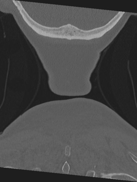 File:Cervical spondylolysis (Radiopaedia 49616-54811 Coronal bone window 68).png