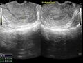 Cesarean scar ectopic pregnancy (Radiopaedia 45975).jpg