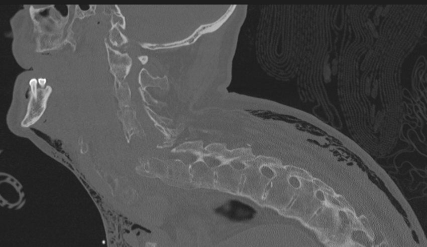 Chalk stick fracture (Radiopaedia 57948-64928 Sagittal bone window 24).png