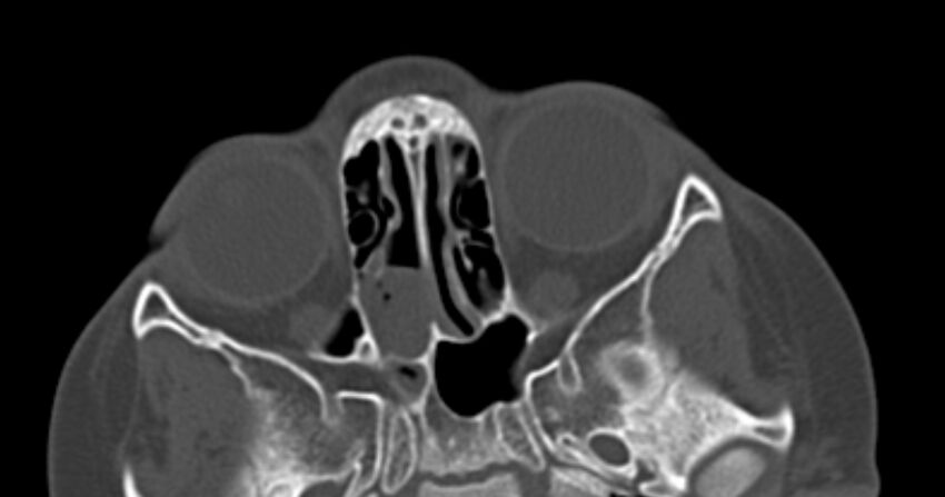 Choanal atresia (Radiopaedia 51295-56972 Axial bone window 39).jpg