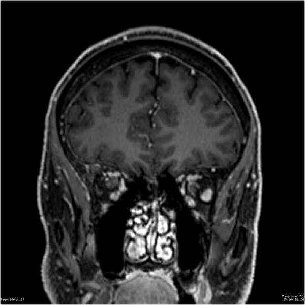 File:Chondrosarcoma of skull base- grade II (Radiopaedia 40948-43654 Coronal T1 C+ 55).jpg