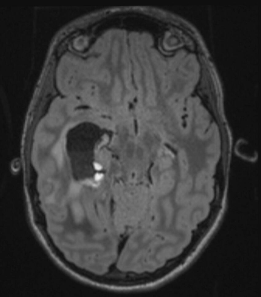 Choroid plexus carcinoma (Radiopaedia 91013-108553 Axial FLAIR C+ 117).jpg