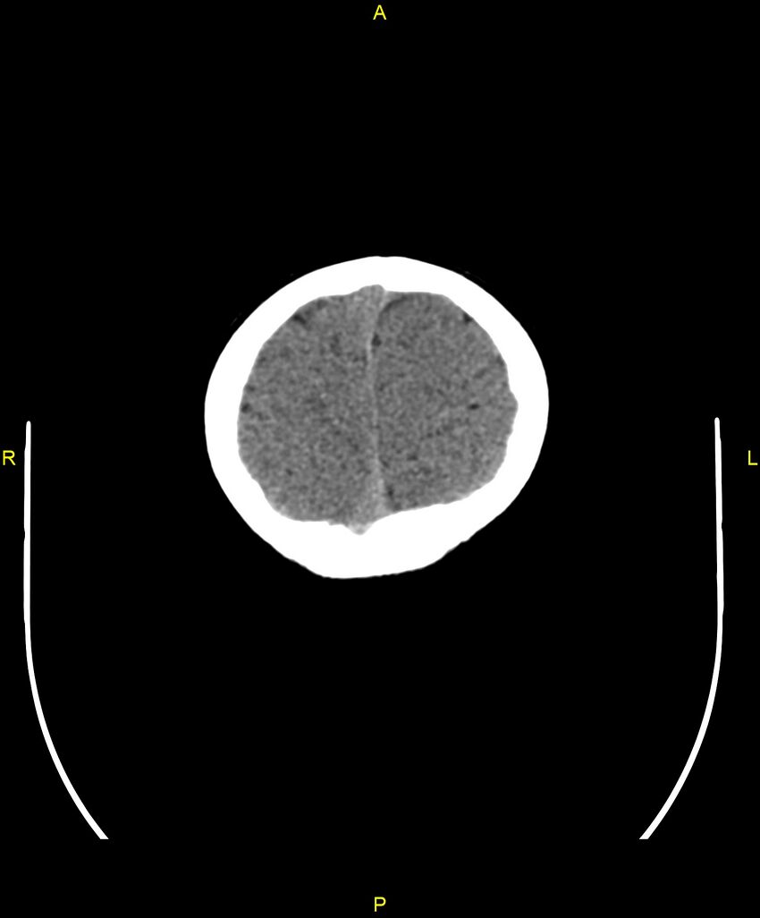 Choroidal fissure cyst (Radiopaedia 89481-106465 Axial non-contrast 109).jpg