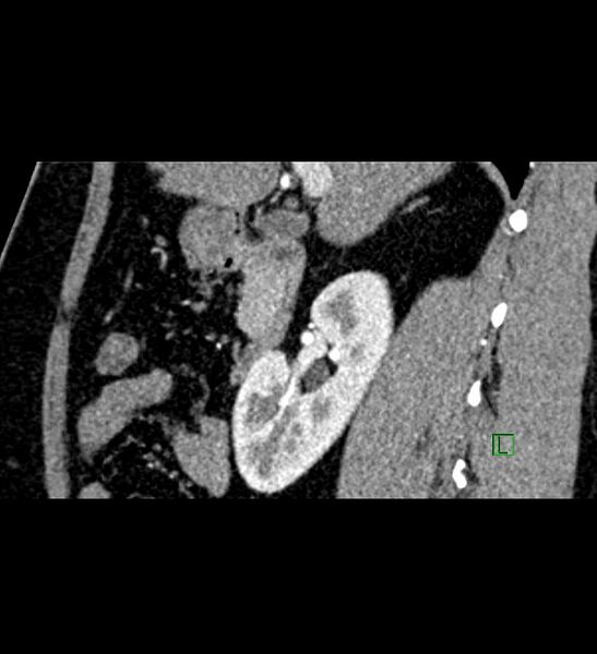 File:Chromophobe renal cell carcinoma (Radiopaedia 84286-99573 F 108).jpg