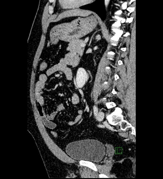 File:Chromophobe renal cell carcinoma (Radiopaedia 84286-99573 I 73).jpg