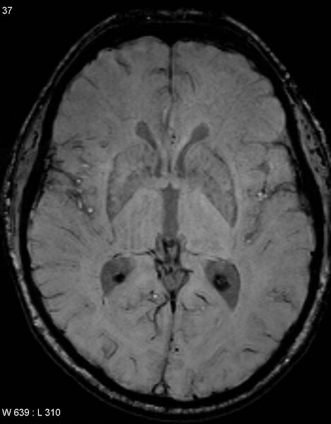 File:Chronic lymphocytic inflammation with pontine perivascular enhancement responsive to steroids (CLIPPERS) (Radiopaedia 37520-39374 Axial SWI 36).jpg