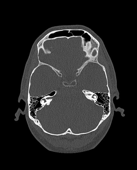 File:Chronic maxillary sinusitis caused by a foreign body (Radiopaedia 58521-65676 Axial bone window 263).jpg