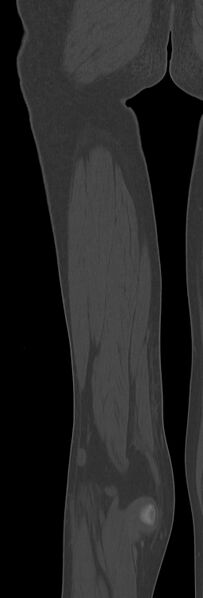 File:Chronic ostemyelitis of the femur with long sinus tract (Radiopaedia 74947-85982 Coronal bone window 67).jpg