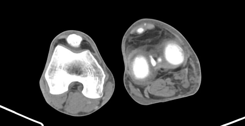 File:Chronic osteomyelitis (with sequestrum) (Radiopaedia 74813-85822 Axial 375).jpg