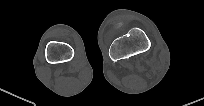 File:Chronic osteomyelitis (with sequestrum) (Radiopaedia 74813-85822 Axial non-contrast 172).jpg