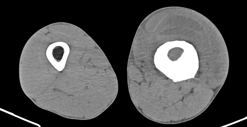 Chronic osteomyelitis (with sequestrum) (Radiopaedia 74813-85822 D 118).jpg
