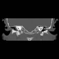 Chronic otomastoiditis (Radiopaedia 27138-27309 Coronal bone window 1).jpg
