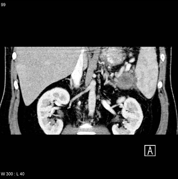 File:Chronic pancreatitis and pseudocysts (Radiopaedia 6724-7935 C 12).jpg