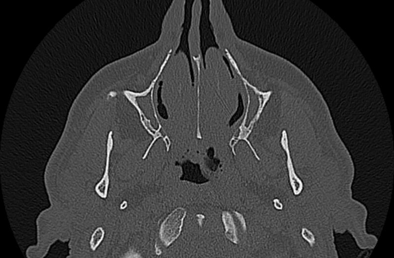 File:Chronic rhinosinusitis (Radiopaedia 65079-74075 Axial bone window 16).jpg