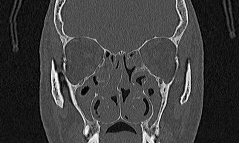 File:Chronic rhinosinusitis (Radiopaedia 65079-74075 Coronal bone window 39).jpg