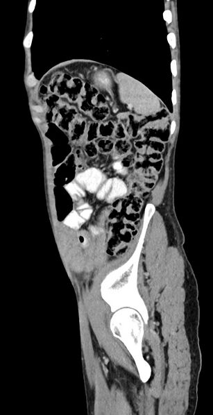 File:Chronic small bowel volvulus (Radiopaedia 75224-86322 C 33).jpg