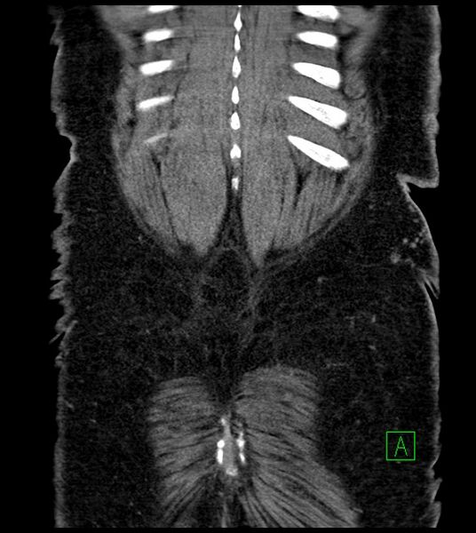 File:Closed-loop small bowel obstruction-internal hernia (Radiopaedia 78439-91096 Coronal non-contrast 93).jpg