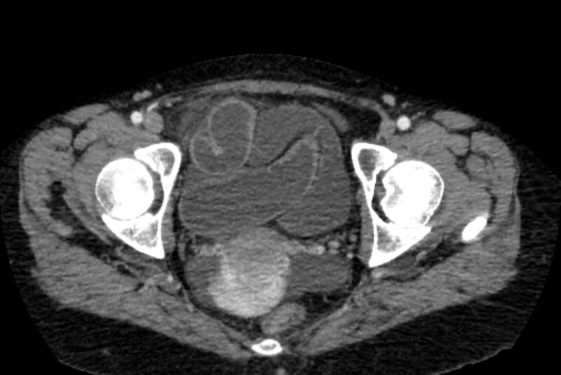 File:Closed loop small bowel obstruction (Radiopaedia 71211-81508 A 159).jpg