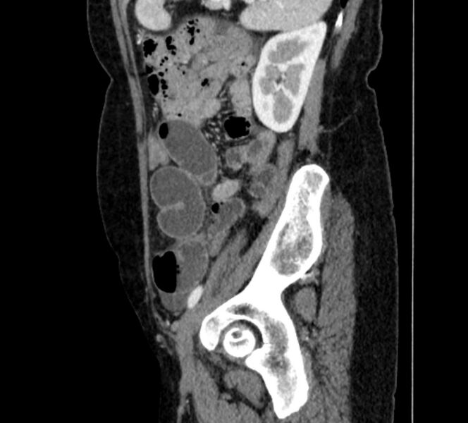 File:Closed loop small bowel obstruction (Radiopaedia 71211-81508 C 126).jpg