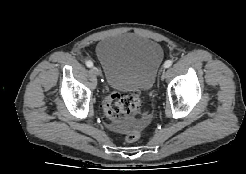File:Closed loop small bowel obstruction with ischemia (Radiopaedia 84180-99456 A 105).jpg