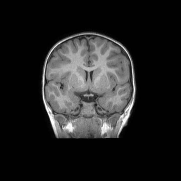 File:Cochlear nerve aplasia - unilateral (Radiopaedia 87910-104413 Coronal T1 23).jpg