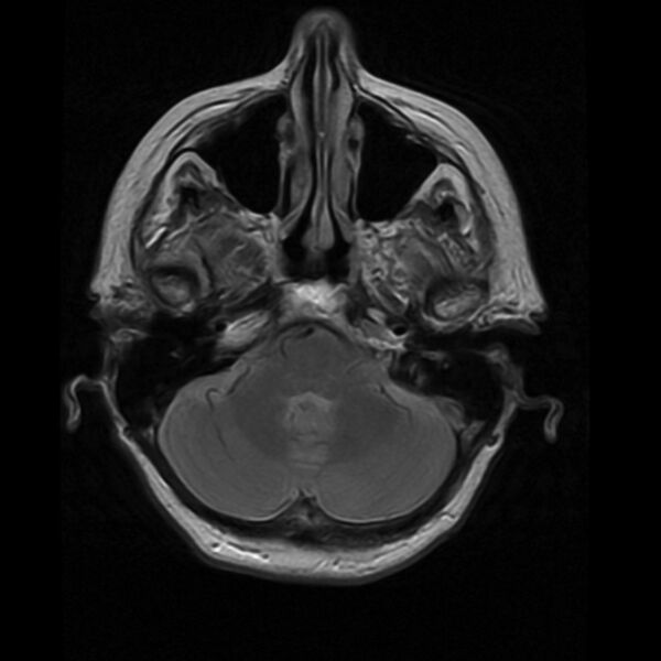 File:Colloid cyst with hydrocephalus (Radiopaedia 9373-10065 Axial PD 4).jpg