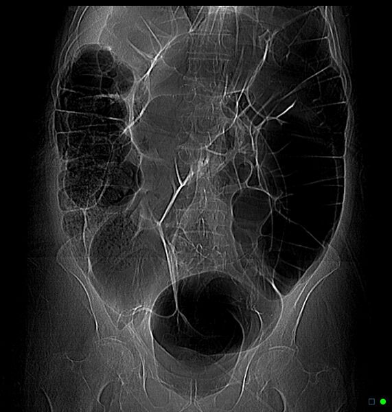File:Colonic pseudo-obstruction (Radiopaedia 20709-20612 Coronal Scout view 1).jpg