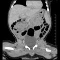 Neonatal neuroblastoma (Radiopaedia 56651-63438 Coronal non-contrast 23).jpg