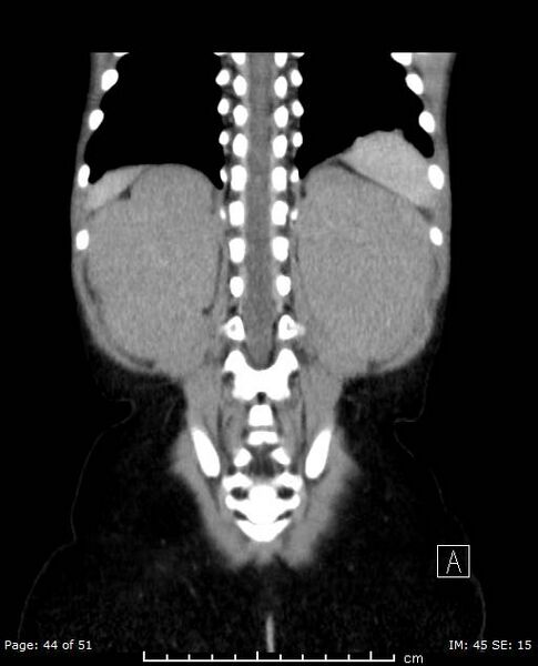 File:Nephroblastomatosis (Radiopaedia 41934-44935 B 44).jpg