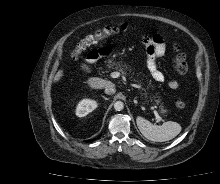 Nephroptosis with inguinal hernia containing perirenal fat (Radiopaedia 56632-63391 C 107).jpg