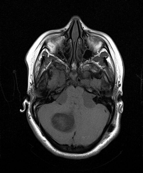 File:Neurofibromatosis type 2 (Radiopaedia 66211-75401 Axial T1 10).jpg