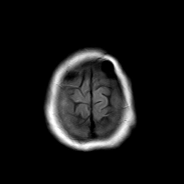 File:Neurofibromatosis type 2 (Radiopaedia 67470-76871 Axial FLAIR 22).jpg