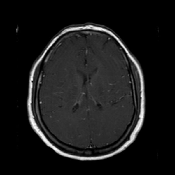 File:Neurofibromatosis type 2 (Radiopaedia 67470-76871 Axial T1 C+ 15).jpg
