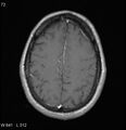 Neurosarcoidosis (Radiopaedia 10930-17204 Axial T1 C+ 15).jpg