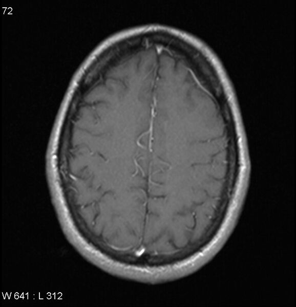 File:Neurosarcoidosis (Radiopaedia 10930-17204 Axial T1 C+ 15).jpg