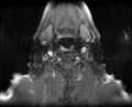 Non-Hodgkin lymphoma - parotid gland (Radiopaedia 71531-81890 Axial T1 C+ fat sat 4).jpg