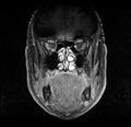Non-Hodgkin lymphoma - parotid gland (Radiopaedia 71531-81890 H 8).jpg