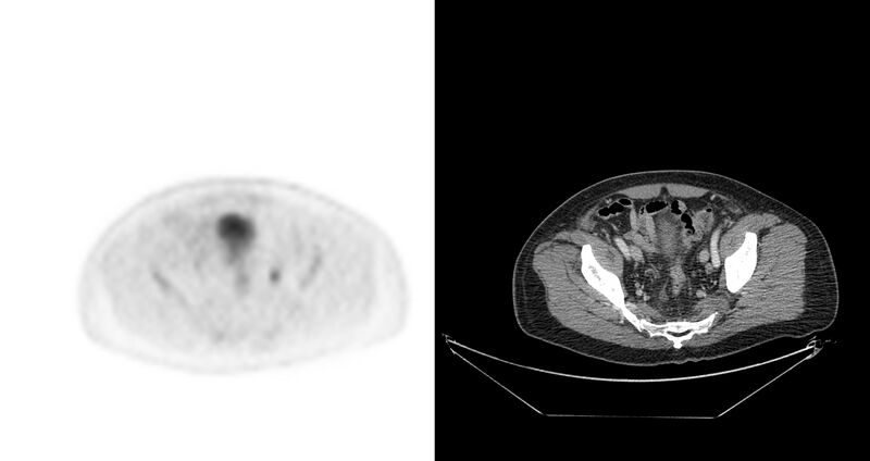 File:Non-Hodgkin lymphoma involving seminal vesicles with development of interstitial pneumonitis during Rituximab therapy (Radiopaedia 32703-33675 axial PET CT 12).jpg